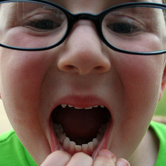 loose-tooth_543
