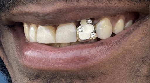 Decorative statement tooth jewelry with crystals on front tooth