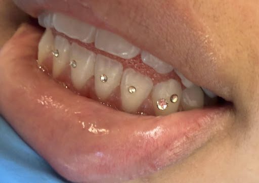 Multiple small crystal tooth gems on natural teeth at Pearly Dental Care